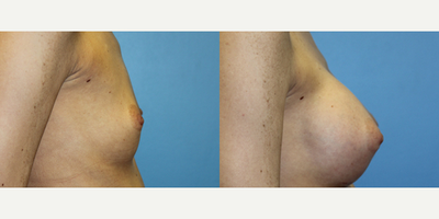 25-34 year old woman treated with Breast Augmentation - Height : 5'7 
WT : 113 
Age : 27 
Implant make : Allergan Natrelle 
style : 304 cc mid profile silicone gel
placement : sf (subfascial)