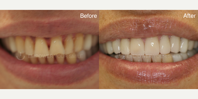 55-64 year old woman treated with Full Mouth Reconstruction - 55 year old woman treated with Full Mouth Reconstruction