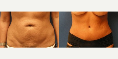 45-54 year old woman treated with Tummy Tuck - After considering her options for body contouring surgery, this 52-year-old Sacramento-area woman chose tummy tuck surgery at our practice. During the procedure, Dr. Yamahata removed excess skin and fat and tightened her abdominal muscles for a comprehensive, long-lasting improvement. Patient Age: 52Patient Gender: Female