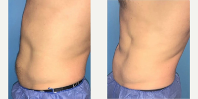 34 year old man treated with CoolTone - 34-year-old male underwent six treatments of CoolTone on the abdomen