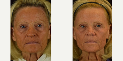 55-64 year old woman treated with Halo Laser - 1 month post-Halo Laser for textural smoothing/pigment. fine lines.
