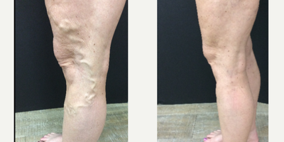 45-54 year old woman treated with Varithena - Dr. Haney used a combination of Varithena, Vnus RF ablation, and a phlebectomy to achieve these great results