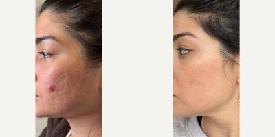18-24 year old woman treated with Phenol Peel, Halo Laser - When acne scars run deep, the treatment plan has to go deeper.This lovely patient came to me with deep acne scarring on her cheeks, along with some skin laxity and early volume loss  which made the scars appear even more pronounced.We took a customized, multi-layered approach:A modified phenol peel to target the scarring, and a Hybrid Fractional laser to refine texture, tone, and signs of aging across the rest of her face.