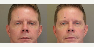 35-44 year old man treated with Ptosis Surgery - This gentleman had been bothered by right upper eyelid ptosis for many years. He underwent right upper eyelid ptosis repair using an internal approach. This technique offers great results with a relatively quick recovery in the hands of an experienced surgeon.