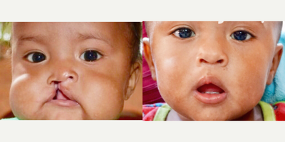 Child treated with Cleft Lip And Palate Repair - This patient was treated for a complete unilateral cleft lip as well as primary rhinoplasty in the same setting. The after photo is 1 year after surgical repair, and demonstrates a natural appearing lip and nose.