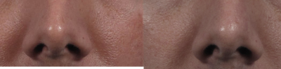 35-44 year old woman treated with Non Surgical Nose Job - 35-44 year old woman treated with Non Surgical Nose Job