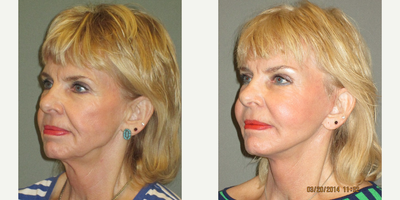 65-74 year old woman treated with Fat Transfer - This patient requested full facial rejuvenation while wanting to maintain a natural appearance. We performed a lower facelift/necklift along with fat grafting to the midface and a lateral brow lift. Her procedures have produced a truly natural overall result with significant improvement in the contour of her midface. Fat grafting to the cheeks has restored this patient's volume that she had lost over the years which lead to a thin, hollow, unhealthy midface prior to procedure. Her face is now much more balanced, with her eyes and her lower face being more complimentary to her cheeks.