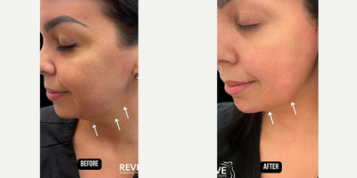 Woman treated with Contour Thread Lift - If you're looking for an instant lift without surgery, a thread lift may be right for you!Thread lifting offers a number of benefits, including:Non-surgical: Thread lifting is a minimally invasive procedure that does not require any incisions or general anesthesia. This makes it a good option for people who are looking for a less invasive way to improve their appearance.Minimal downtime: There is very little downtime associated with thread lifting. Most patients are able to return to their normal activities within a few days of the procedure.Natural-looking results: Thread lifting produces natural-looking results that can last for up to two years. The threads gradually dissolve over time, and the body's natural collagen production is stimulated, which helps to maintain the results.