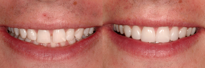 Prepless Veneers - Spaces were closed and balance achieved with six Durathin Prepless Veneers - no drilling, no anesthetic.