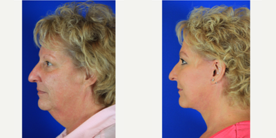 Patient treated with Deep Plane Facelift - Patient treated with Deep Plane Facelift