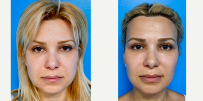 35-44 year old woman treated with Buccal Fat Removal - Buccal Fat Removal