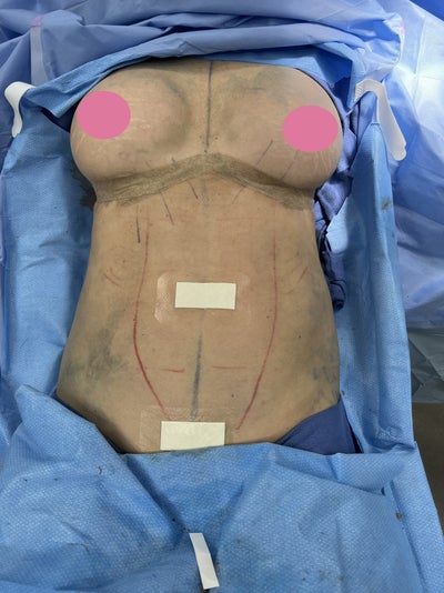 Tummy Tuck Tampa  Abdominoplasty by Dr. Markelov