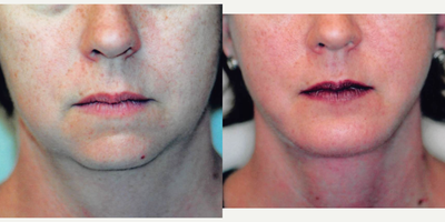 35-44 year old woman treated with Buccal Fat Removal - Buccal Fat removal in our office.