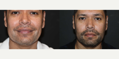 Man treated with Beard Transplant - Man treated with Beard Transplant