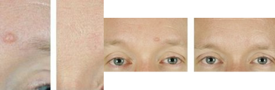 Mole Removal Before & After - Patient had mole removed from brow/temple region.
