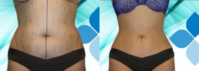 35-44 year old woman treated with Body Jet - Colombian Liposculpture with Body Jet