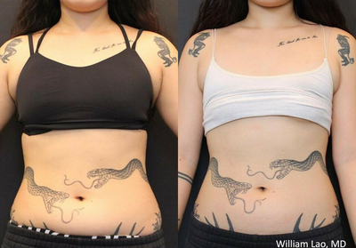 Woman treated with Emsculpt - Emsculpt Neo nonsurgical fat reduction and muscle augmentation. This patient has only completed half of her treatment and already has such obvious results!
