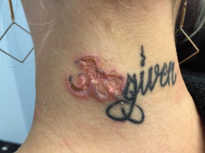 I'm 3 weeks post tattoo removal and it feels irritated. Is 