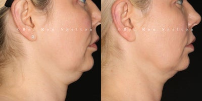 45-54 year old woman treated with Sofwave, Kybella, Nonsurgical Neck Lift, Nonsurgical Facelift, Skin Tightening, Sclerotherapy - 10 Weeks Post Miria Neck, Sofwave Cheeks & 26 Weeks Post KybellaAbove patient received a combination of treatments demonstrating impressive results for non-surgical skin tightening, lifting, and contouring. At 10 weeks post-Miria treatment on the neck, there's a visible improvement in skin firmness, helping to reduce sagging and enhance neck contours. Additionally, Sofwave applied to the cheeks delivers a lifting effect, smoothing and refreshing the mid-face for a naturally rejuvenated look. Kybella treatment treatment resulted in a more defined jawline and reduced submental fullness, as Kybella targets and dissolves excess fat under the chin. Together, these treatments worked synergistically, using advanced technology to achieve a lifted, sculpted, and refreshed appearance without the need for surgery.