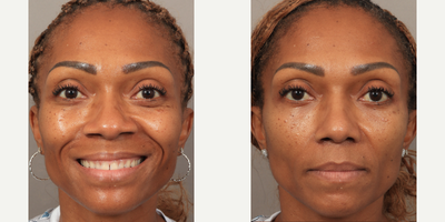 45-54 year old woman treated with Rhinoplasty, African American Rhinoplasty - 1.5 Months Post-op. Performed by Dr. Lexie Wang using the patients own rib cartilage for her rhinoplasty. Our lovely patient felt like her nose didnt fit her face, with a bulbous tip and wide nostrils. After waiting decades, she finally did something just for herself, and the results are already incredible!