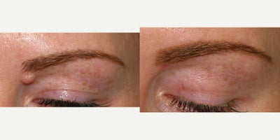25-34 year old woman treated with Mole Removal - Mole removal using shave technique.