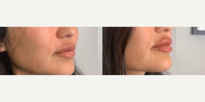 25-34 year old woman treated with Lip Augmentation - Lip augmentation using 1 syringe of Juvederm Ultra done by Cyndi, RN BSN