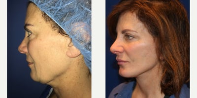 55-64 year old woman treated with Facelift - Patient is 3 months post op
