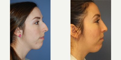 25-34 year old woman treated with Rhinoplasty - Patient underwent a rhinoplasty procedure 10 months ago.