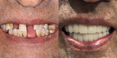 65-74 year old man treated with Snap-On Smile - Top and bottom Snap-On