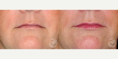 51 year old woman treated with Restylane Refyne to upper and lower lips - 51 year old woman treated with Restylane Refyne to upper and lower lipsPhotos depict before and 2 weeks after procedure.
