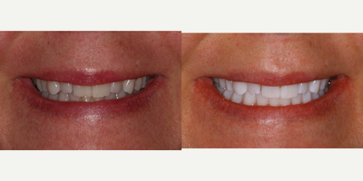 35-44 year old woman treated with KoR Teeth Whitening - This patient boosted her confidence and satisfaction with her smile using the KOR whitening system.