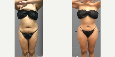 25-34 year old woman treated with AirSculpt - Almost every woman covets the hourglass figure, characterized by a slim torso and a wide, contoured bust. The patented HipFlip procedure instantly delivers this shape by removing fat, then using it to naturally enhance the hips. This patient, just six months after her treatment, sculpted her full abs and cured her hip dips at once.
