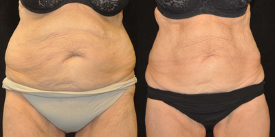 Velashape - Photos provided courtesy of Syneron, Todd C. Becker, MD