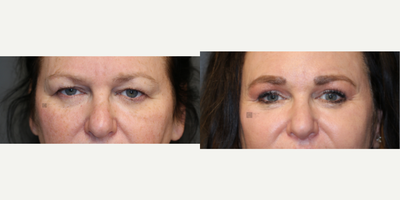 Enigmalift and fat transfer. - Enigmalift Browlift and eyelid lift with fat transfer and non-surgical neck tightening and lip lift.