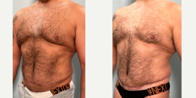 55-64 year old man treated with Tummy Tuck Revision - Male tummy tuck revision