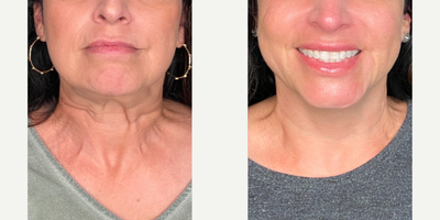 45-54 year old woman treated with Jeuveau, Dysport, Botox - This client had Jeuveau placed in her neck to soften the appearance of her Platysma bands.