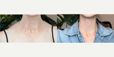 35-44 year old woman treated with Jeuveau, Botox, Dysport - This client had Jeuveau placed in her neck to soften the appearance of her Platysma bands.