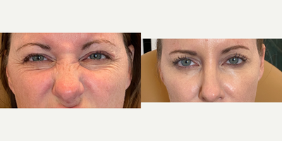 35-44 year old woman treated with Jeuveau, Dysport, Botox - This client had Jeuveau placed in her forehead and around her eyes for her crows feet to soften her lines.