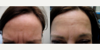 Woman treated with Dysport - Woman treated with Dysport.