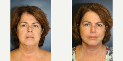 55-64 year old woman treated with Facelift (The Angle Lift) - 60 year old woman treated with a facelift (The Angle Lift)