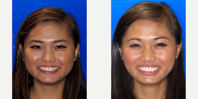 25-34 year old woman treated with Zoom Whitening - Patient had 4 Zoom in house treatments done. She was also treated with Invisalign for 18 months.