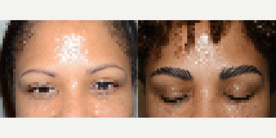 35-44 year old woman treated with Eyebrow Transplant - This 39 year old black female achieved impressive results with an eyebrow transplant.