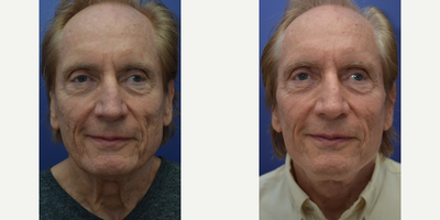 65-74 year old man treated with Sculptra Aesthetic, Subcision - This 69 year old patient wanted to address the hollowing in his cheeks and visible scarring from acne with Sculptra. He also underwent subcision around his cheeks for the acne scarring. These photos were taken 6 weeks after his third Sculptra injection.