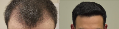 25-34 year old man treated with FUE Hair Transplant, PRP for Hair Loss, Exo-Xom - Our clients 6 month follow up, at only 50% density! Another 50% density to come over the next 6 months! Looks phenomenal, and our client is extremely happy with his results. Client had a total of 3700 grafts done, with approximately 2500 for reconstruction of the hairline, and the subsequent areas, and about 1200 grafts to add density to the crown/vertex, which was thinning and see through.