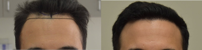 25-34 year old man treated with FUE Hair Transplant, PRP for Hair Loss, Exo-Xom - Our clients 6 month follow up, at only 50% density! Another 50% density to come over the next 6 months! Looks phenomenal, and our client is extremely happy with his results. Client had a total of 3700 grafts done, with approximately 2500 for reconstruction of the hairline, and the subsequent areas, and about 1200 grafts to add density to the crown/vertex, which was thinning and see through.