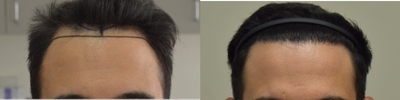 25-34 year old man treated with FUE Hair Transplant, PRP for Hair Loss, Exo-Xom - Our clients 6 month follow up, at only 50% density! Another 50% density to come over the next 6 months! Looks phenomenal, and our client is extremely happy with his results. Client had a total of 3700 grafts done, with approximately 2500 for reconstruction of the hairline, and the subsequent areas, and about 1200 grafts to add density to the crown/vertex, which was thinning and see through.