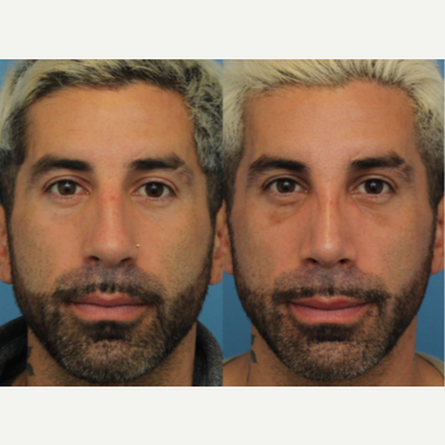 35-44 year old man treated with Septoplasty - Septoplasty with Dr. Chasan