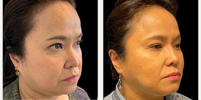 55-64 year old woman treated with Nonsurgical Facelift, Renuvion for Facial Resurfacing - Patient: Female, 59Procedure: Renuvion Mini FaceliftRecovery: 9 months