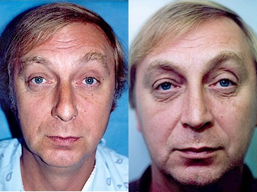 Man treated with Septoplasty and Rhinoplasty - Man treated with Septoplasty and Rhinoplasty