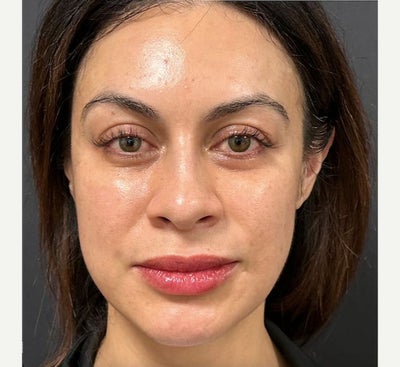 25-34 year old woman treated with Facial Fat Transfer - Facial Fat Injection